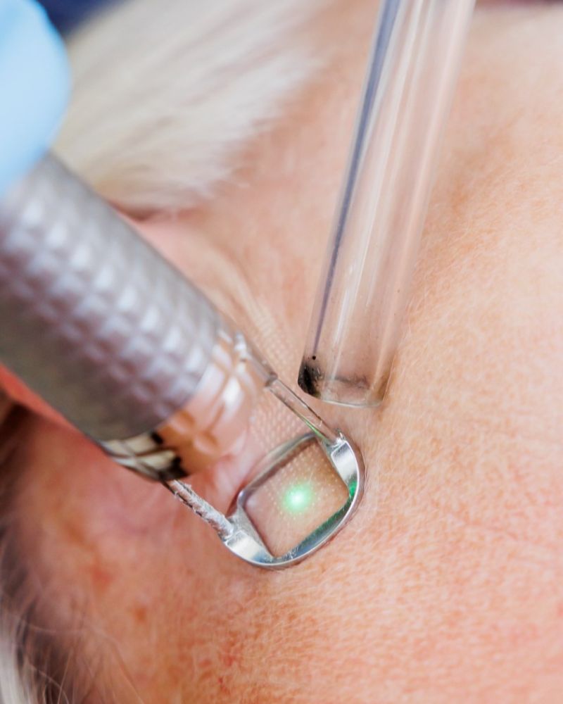 fotona-south-africa-treatment